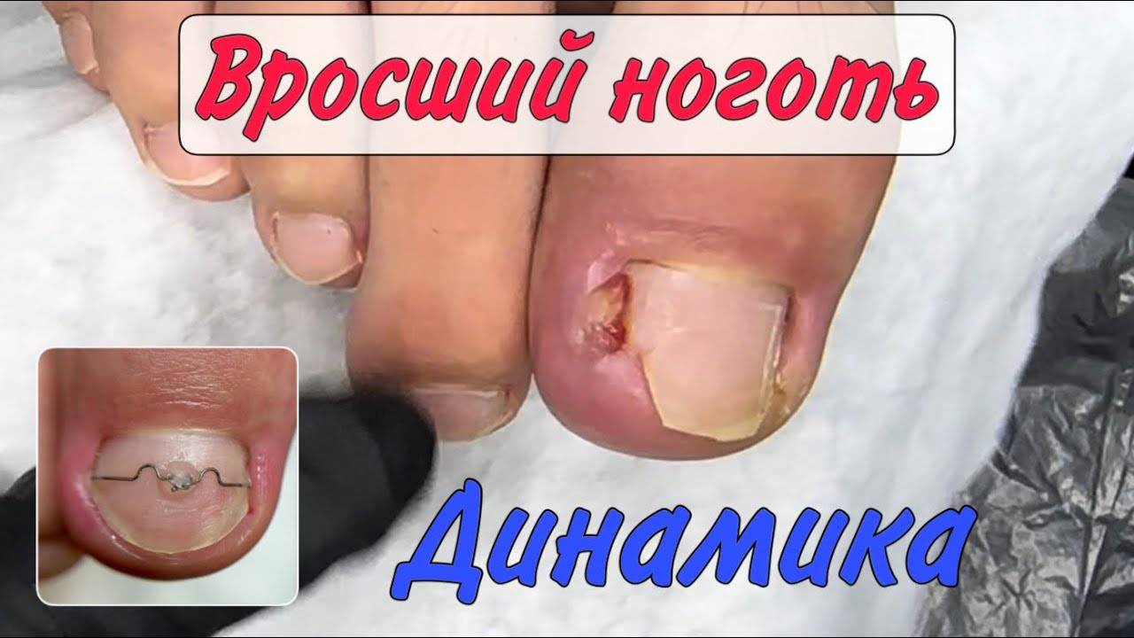Вросший ноготь и установка скобы 3ТО