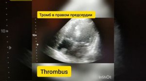 ТРОМБ В ПРАВОМ ПРЕДСЕРДИИ😵 ЭХОКАРДИОГРАФИЯ 👉Echocardiography ⚡CLOT /THROMBUS in RA🔥