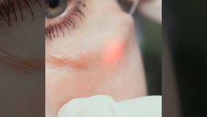 Ендоліфтінг | Эндолифтинг | Лифтинг лица |   Подтяжка лица |  Лазерная медицина Харьков