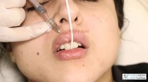 TeosYaL Filler For The Lips And Nose - Dr. Noury Adel