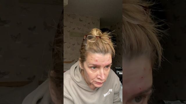 Tox treatment DAO, neck-lift and forehead #aesthetics #anti wrinkle #neck смотреть онлайн