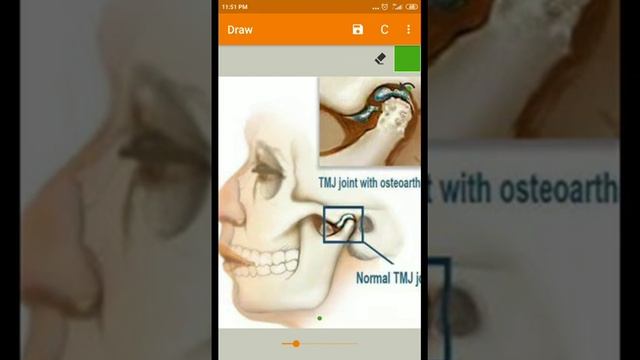 Osteoarthritis Temporomandibular joint смотреть онлайн