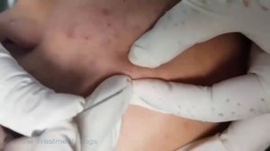 Выдавливание черных точек и прыщей #129 ¦   Blackheads Removal