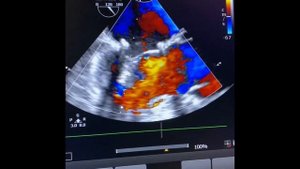 Mitral qapaq temiri / Barlov / Пластика митрального клапана / Mitral valve reconstruction / Baku