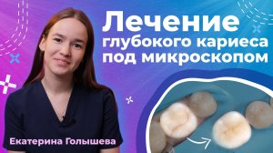 Как лечат кариес под микроскопом? | Реставрация жевательного зуба композитами