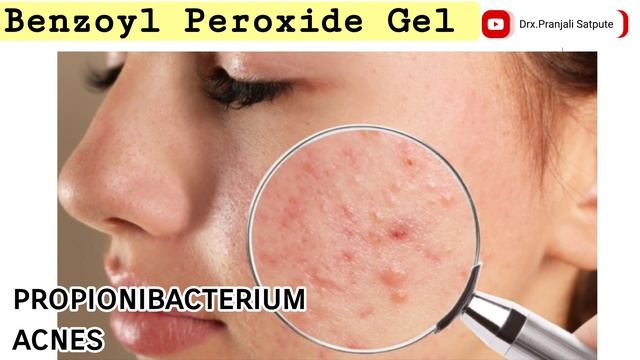 Benzoyl Peroxide Gel 2.5 How To Use | Persol ac 2.5 gel | Pimple Acne ka ilaj | Pranjali Satpute