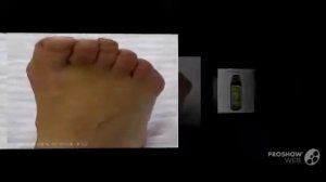 Корректор для большого пальца Valgus Plus