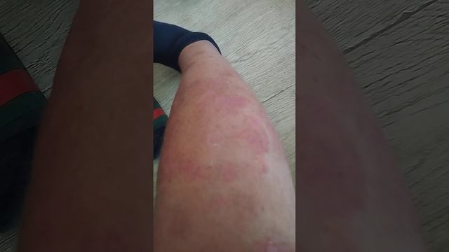 Псориаз, новые способы лечения. Тестируем новый Фу-Фан.