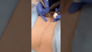 Удаление рубца лазером