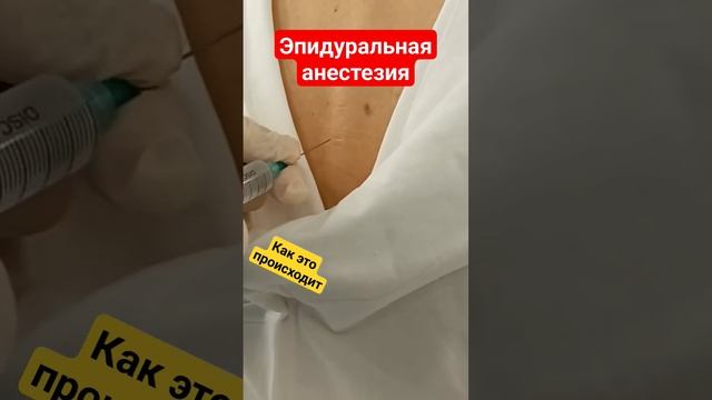Эпидуральная анестезия