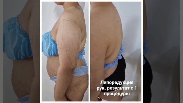 липоредукция рук, эффект от 1 процедуры. Жир в данную зону не возвращается