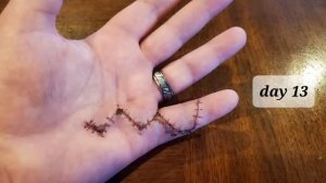 hand surgery healing- time lapse. 36 days in 90 seconds.
