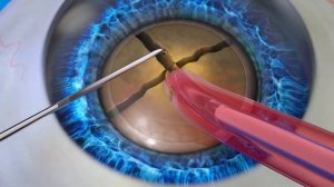 Фемтолазерное сопровождение катаракты компания LensAR