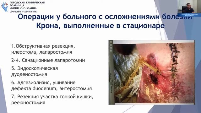 32. Успешное хирургическое лечение поздних осложнений болезни Крона в условиях пандемии COVID-19