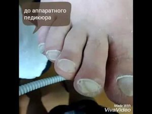 Аппаратный педикюр.