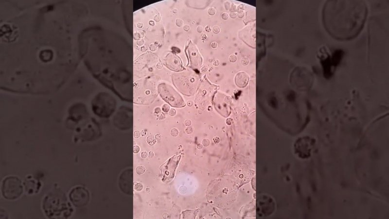 Mixed epithelial cell with white blood cells in urine