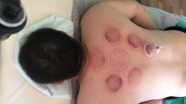 Хиджама, капиллярное кровопускание