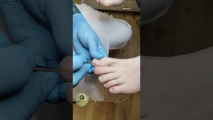 Болит сбоку ногтя? Подкладываем Кополин под ноготь.