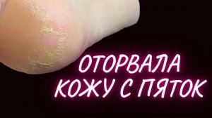ОНА ОТОРВАЛА КОЖУ С ПЯТОК | ПЕДИКЮР | ПЕДИКЮР С ГЛУБОКИМИ ТРЕЩИНАМИ