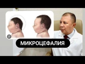 #МИКРОЦЕФАЛИЯ  КАКИЕ УЛУЧШЕНИЯ ? ? ?