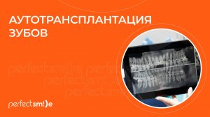 👉 Аутотрансплантация зубов: что это и для чего проводят?