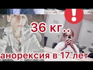 Моя история РПП Анорексия|36 килограмм в 17 лет|У парней тоже бывает рпп!
