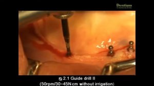 Dentium - SlimLine Miniball Attachment