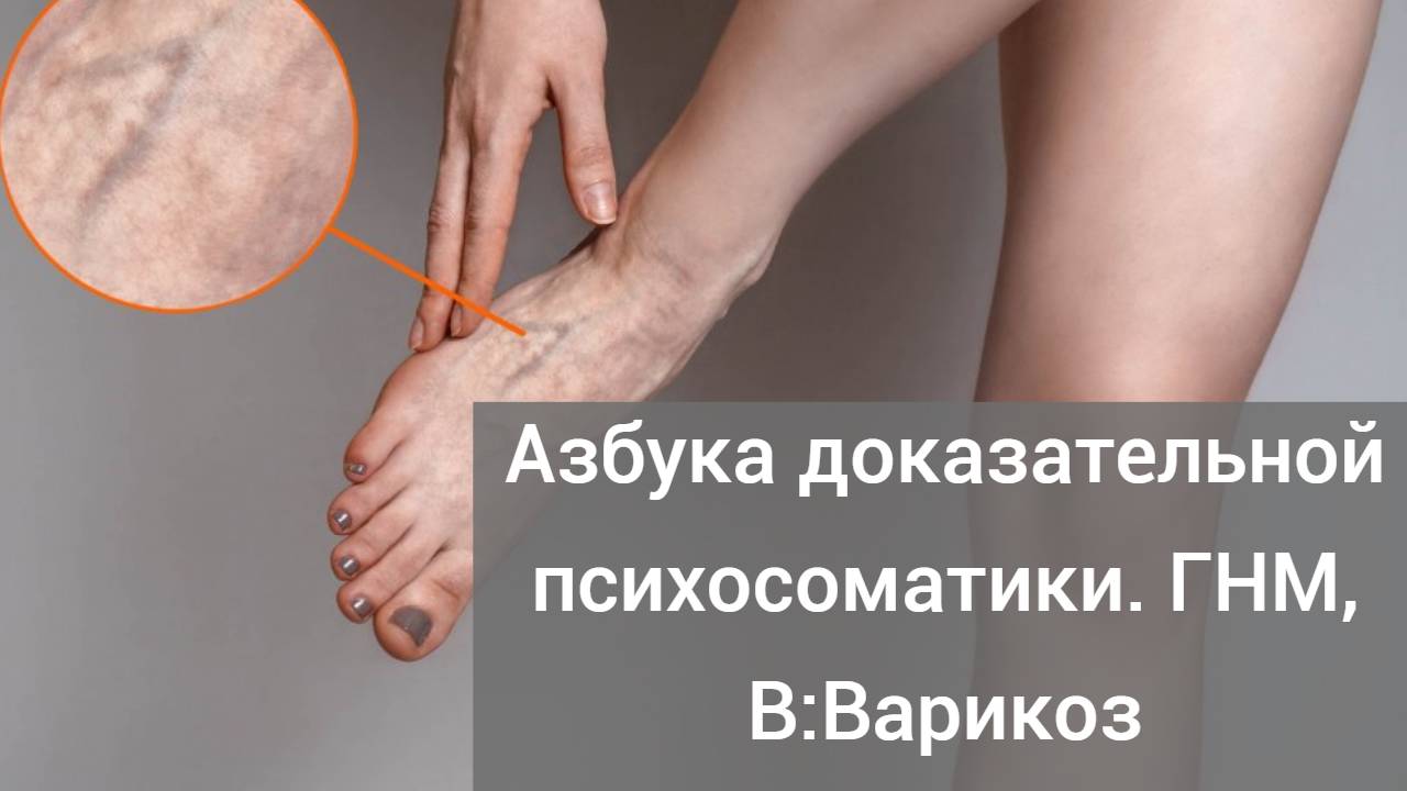 Азбука доказательной психосоматики. ГНМ по Хамеру: “В”: варикоз