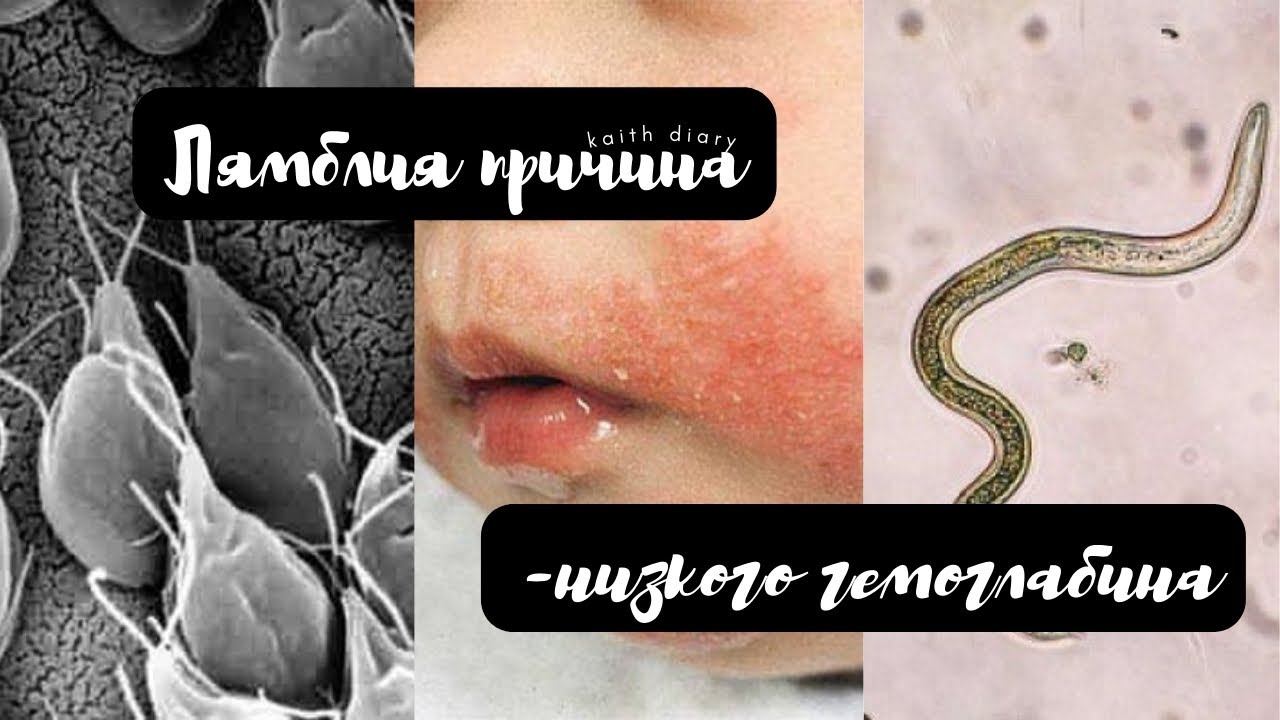 Лямблия причина -анемий.#анемия#железодифицитная анемия.
