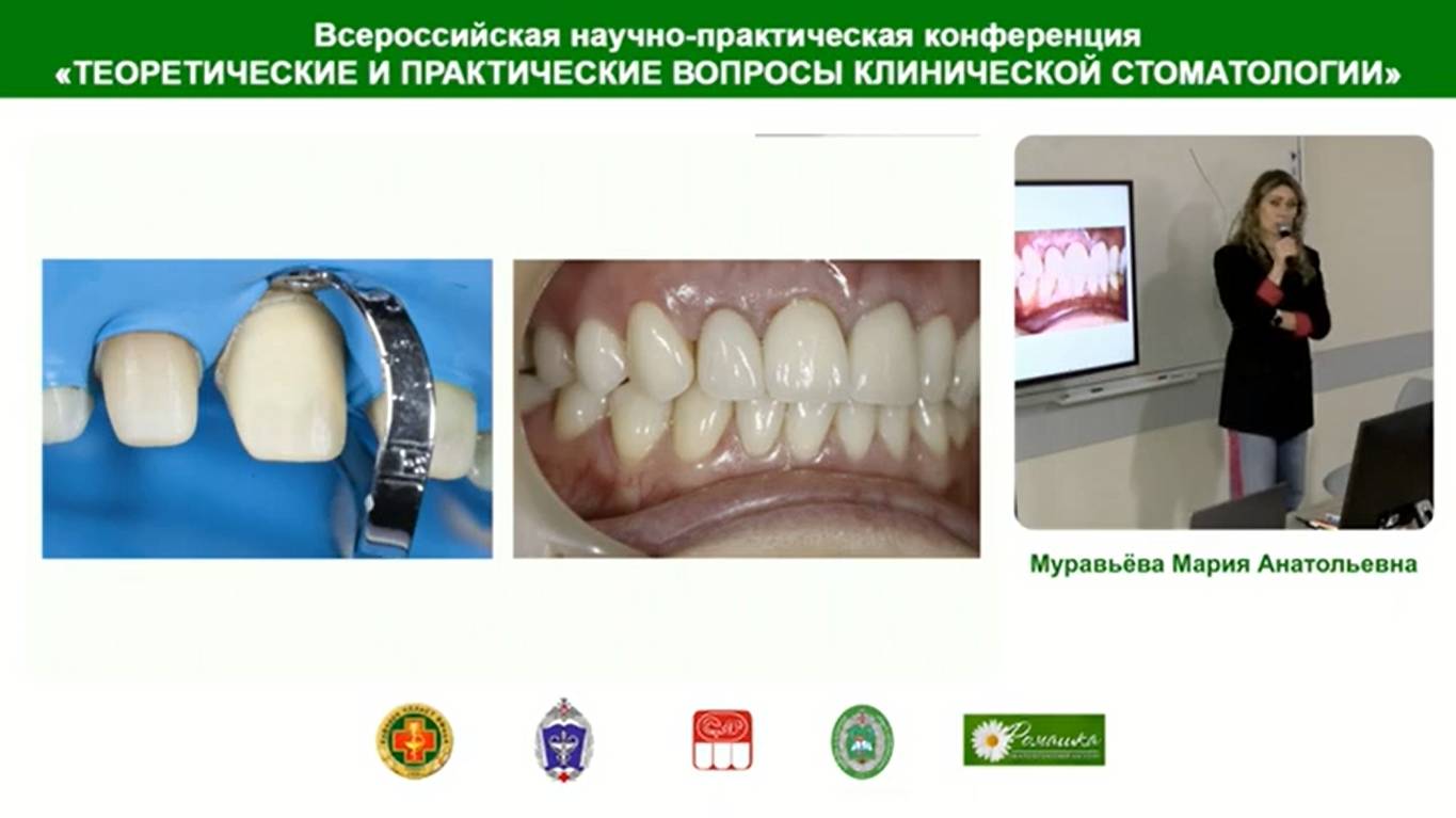 Муравьёва М.А. Алгоритм прямой реставрации фронтальных зубов при выраженных дисколоритах