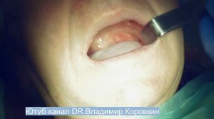 Проводниковая анестезия для имплантации в области 36.