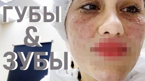 Исправляю ошибки молодости после ортодонта за 1.5 лимона. Артроз в 26 лет. Впервые сделала губы