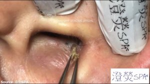 Giant Ear Acne Removal Blackheads - How To REMOVE BLACKHEADS | Part 1