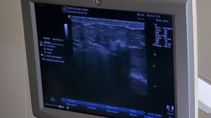 Вакуум-ассистированная тотальная биопсия фиброаденомы (малоинвазивное удаление)