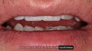 Технология MOCKUP (Мокап) в клиниках стоматологии "МЦ Интердентос"