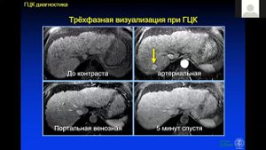 Гепатоцеллюлярный рак