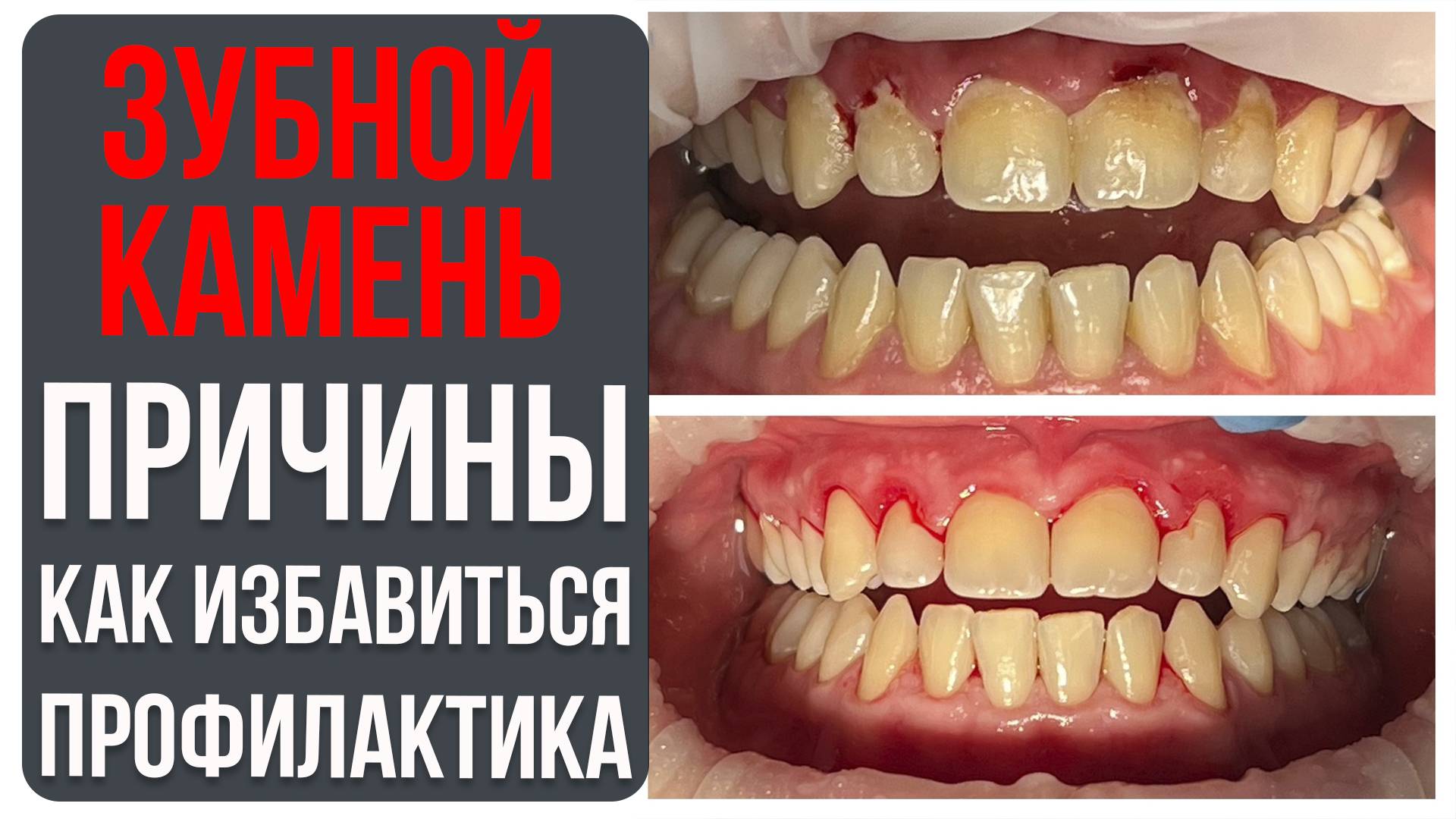 Зубной Камень и Зубной Налёт [Причины появления, Как избавиться, профилактика]