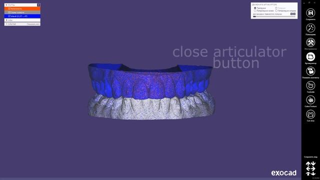 Opening bite with saving position of upperjaw in virtual articulator in Exocad