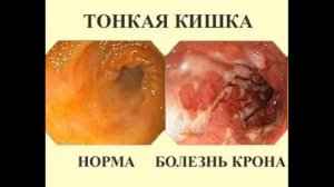 Болезнь Крона Лечение по методу Шевченко