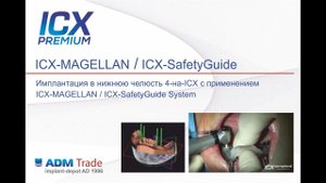 Имплантация в нижнюю челюсть 4-на-ICX с применением программы ICX-MAGELLAN
