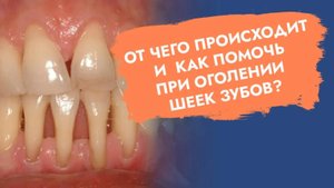Почему оголяются корни зубов? К кому идти?