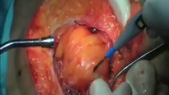 RADICAL HYSTERECTOMY AND PELVIC LYMPHADENECTOMY PART 1