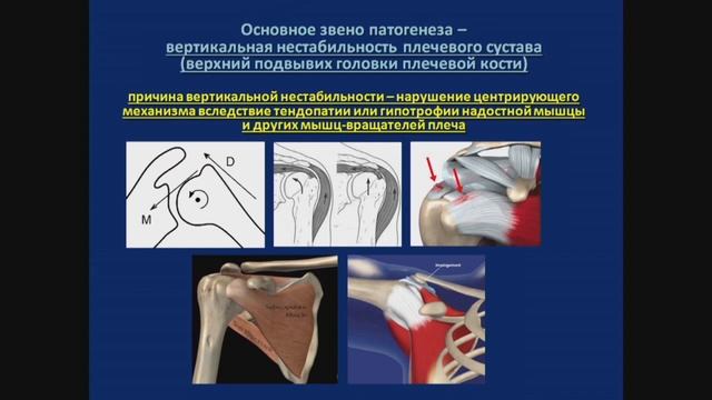 Боль в плечевом суставе, импиджмент синдром