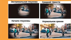 ГЛАУКОМА, АТРОФИЯ ЗРИТЕЛЬНОГО НЕРВА  Применение виофтанов