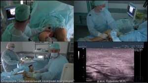 Эндовазальная лазерная коагуляция
