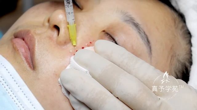 Trueself PLLA 400 Injection of fine lines around the eye