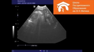 Лимфома кишечника /2