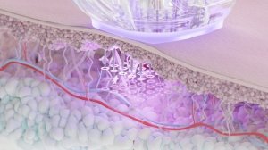 ВАКУУМНЫЙ RF (РФ) ЛИФТИНГ КОЖИ ELLISYS SENSE