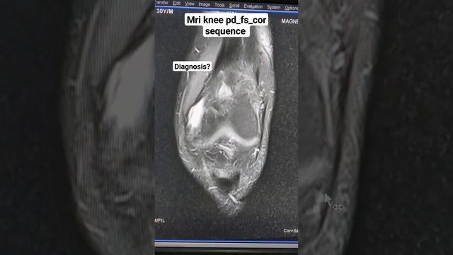 Mri Knee Coronal view #radiodiagnosis #sequence #imaging #pathology #paramedical #radiology#limbs