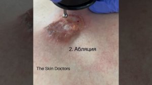 Келоидный рубец